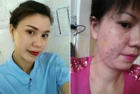 Cách trị mụn bọc, mụn cám, mụn ẩn trong da, thâm, nám cho khách hàng - MSKH: TN14066